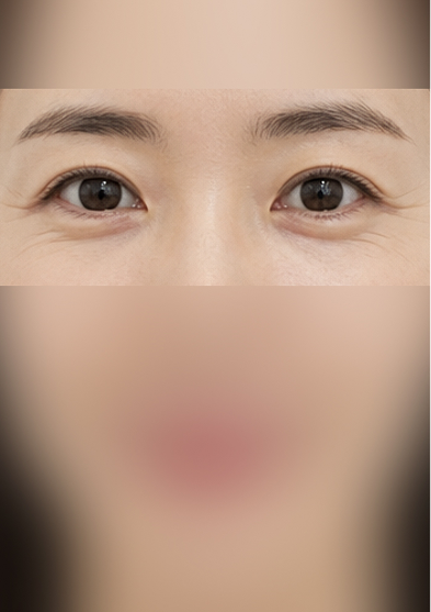 CASE 01 눈가 주름 시술 전