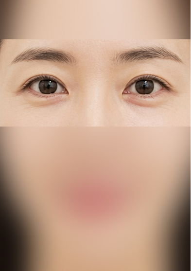 CASE 01 눈가 주름 시술 후 6개월