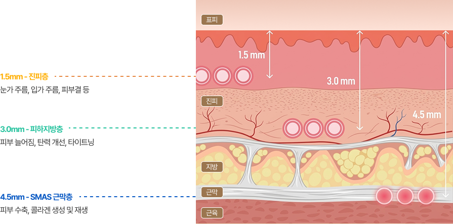 피부층 깊이와 상태에 따른 초개인형 맞춤 시술